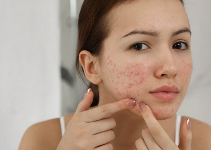 Ultimativna skincare rutina za tinejdžersku kožu sklonu aknama
