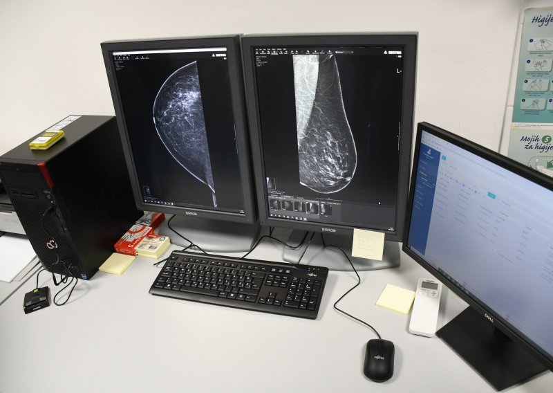 Uskoro mobilni mamograf u ruralnim dijelovima Splitsko-dalmatinske županije