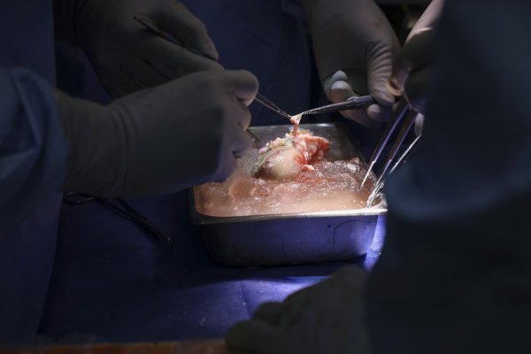 Transplantacija svinjskog GMO bubrega čovjeku